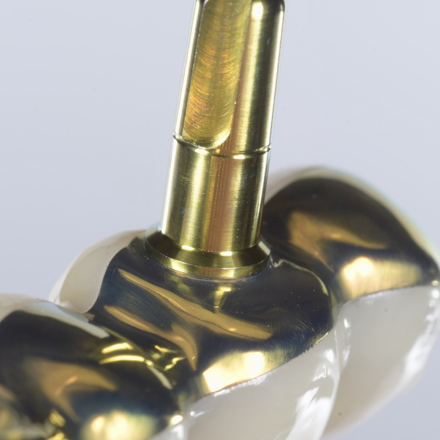 Prothèse sur implants